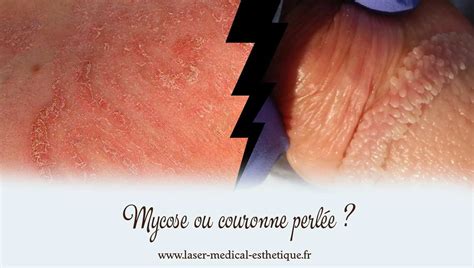 PAPULES PERLÉES DU GLAND OU COURONNE。